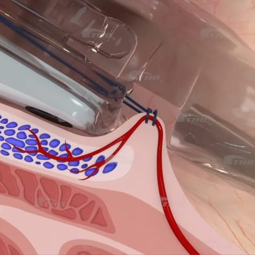 THD® Anolift cierre de arterias