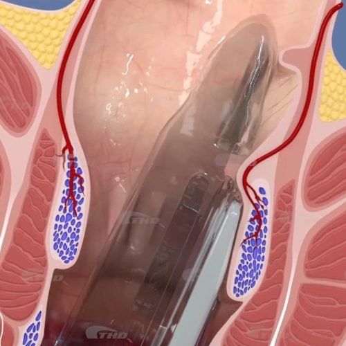 THD® Anolift localizacion doppler